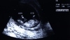 Ultrazvuk dítěte 