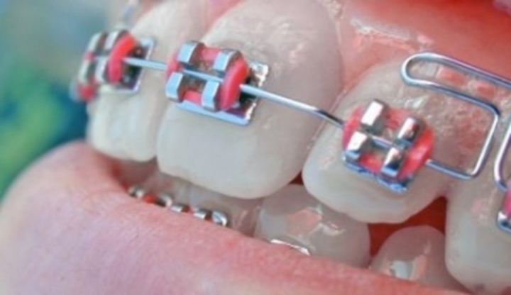 Rovnátka na bílých zubech 